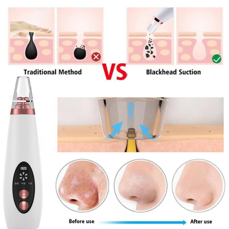 Black Head Remover